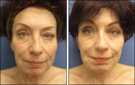 no scars at all behind the ears!